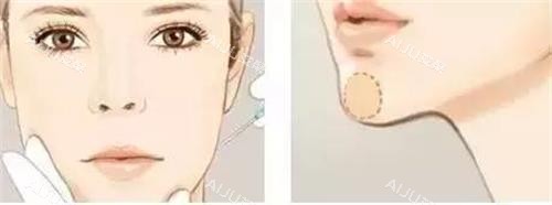 注射垫下巴的部位 注射垫下巴的部位