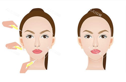 面部填充对比展示