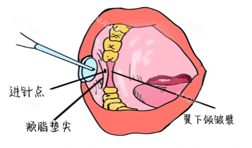 牙周内注射麻醉