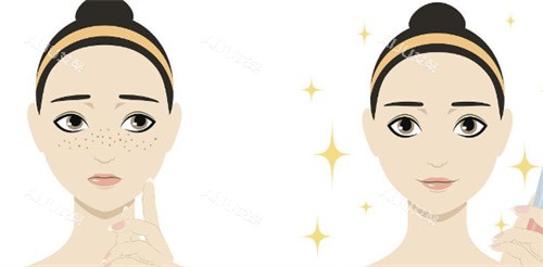 激光祛斑对比示图