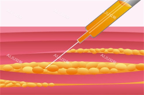 吸脂手术过程原理卡通图 吸脂手术过程原理卡通图