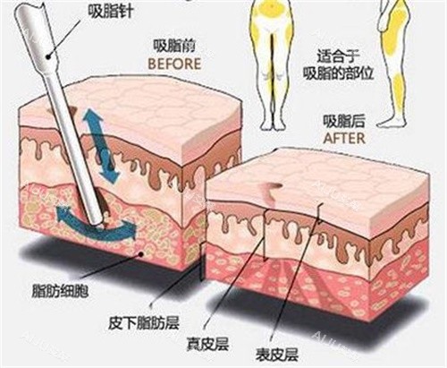 吸脂原理示意图 吸脂原理示意图