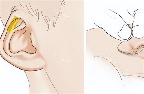 耳再造耳部畸形动画展示