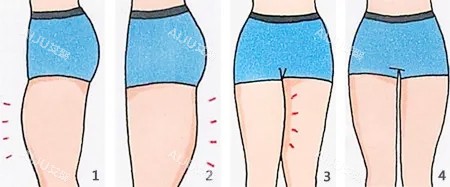 大腿吸脂卡通图