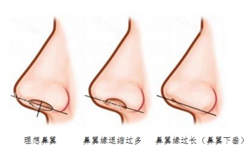 鼻翼退缩矫正术图片实例