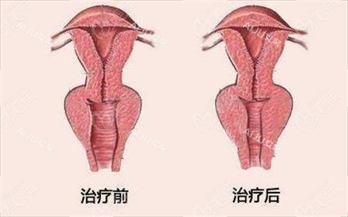 女性阴道紧缩手术前后对比动画图
