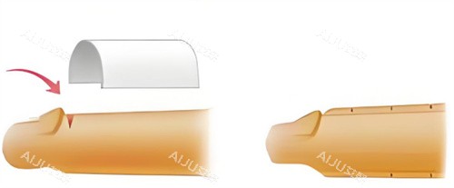 男性增粗手术示意图