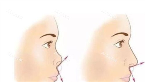 隆鼻前后对比示图 隆鼻前后对比示图