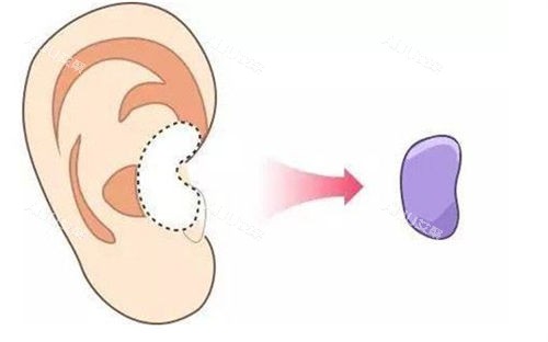 耳软骨隆鼻移除位置展示图 耳软骨隆鼻移除位置展示图