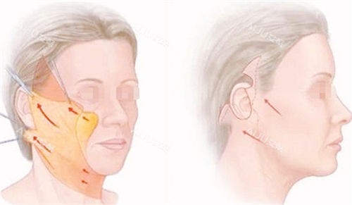 拉皮手术前后成果对比展示图