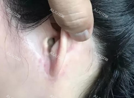 拉皮手术疤痕图