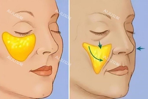 苹果肌下垂于正常苹果肌卡通对比图