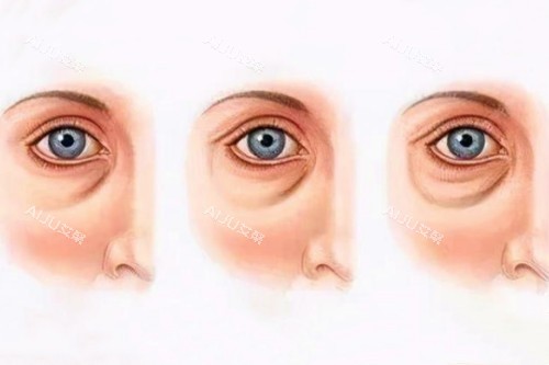 眼袋加深卡通图