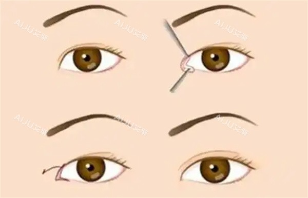 开眼角整形手术