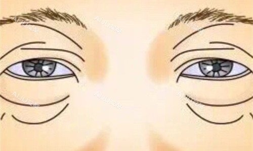 眼袋展示卡通图 眼袋展示卡通图