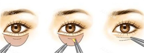 内切法祛眼袋的手术步骤 内切法祛眼袋的手术步骤