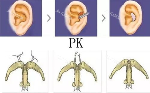 耳软骨支架隆鼻图