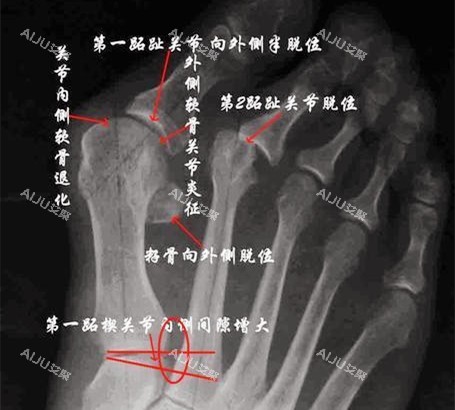 大脚骨X光片