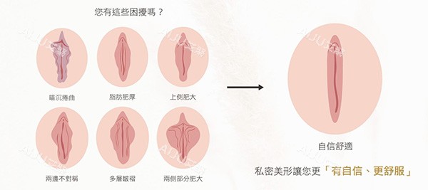 外阴阴唇整形前后变化 外阴阴唇整形前后变化