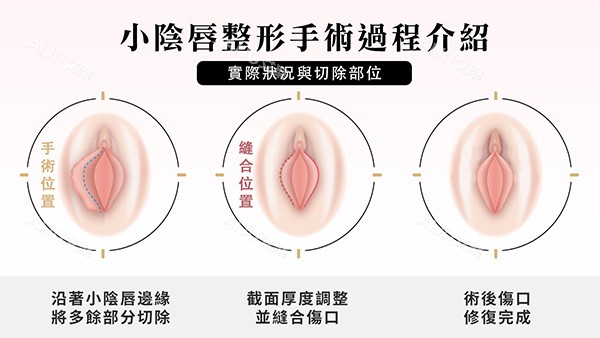 阴唇一边长一边短改善照片 阴唇一边长一边短改善照片