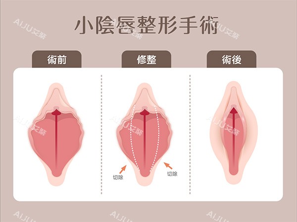 小阴唇整形手术 小阴唇整形手术