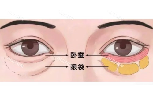 眼袋、卧蚕区分图