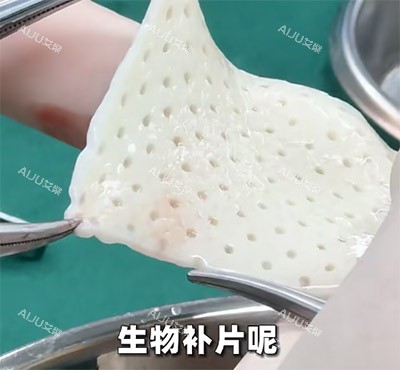 生物补片改善增大增粗照片