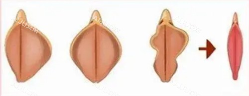 阴唇整形前后对比图 阴唇整形前后对比图