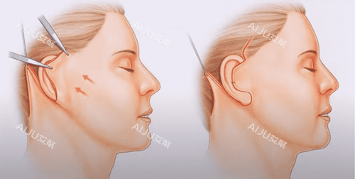北京加减美v9手术优势提拉量大作用明显