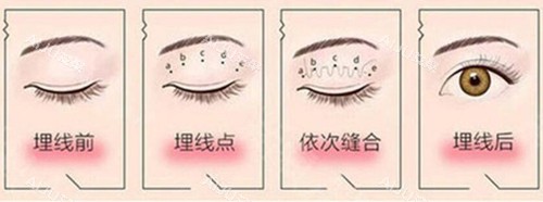埋线双眼皮过程示意图片