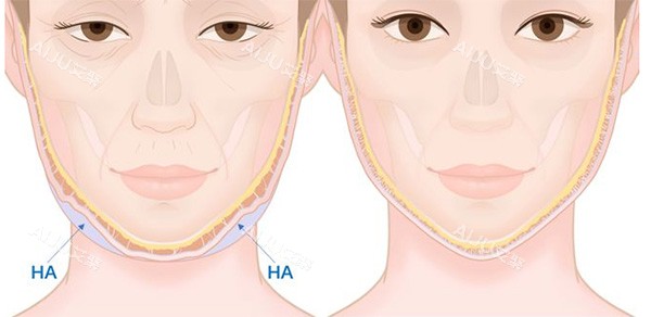 馒化脸改善前后变化 馒化脸改善前后变化