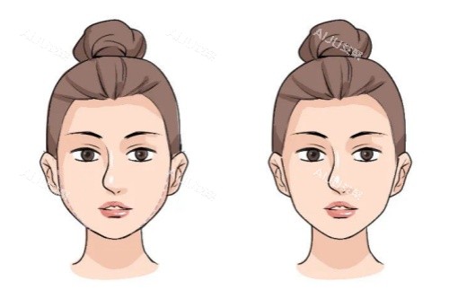 面部馒化修复卡通对比图 面部馒化修复卡通对比图