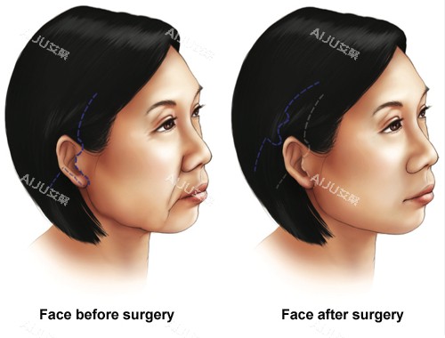 面部提升手术前后对比图 面部提升手术前后对比图