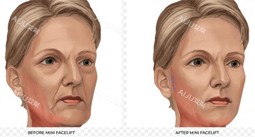 改善皮肤皱纹的面部提升 改善皮肤皱纹的面部提升