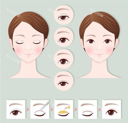 切开双眼皮手术前后对比和过程 切开双眼皮手术前后对比和过程