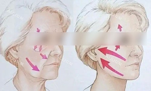 做拉皮手术前后动画图 做拉皮手术前后动画图