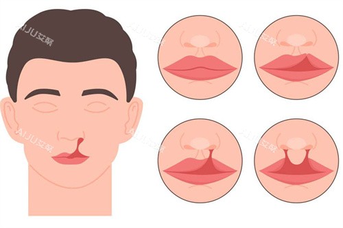 成人唇裂及唇腭裂 成人唇裂及唇腭裂