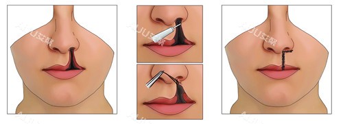 唇裂修复 唇裂修复