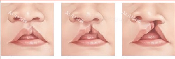 单侧唇裂 单侧唇裂