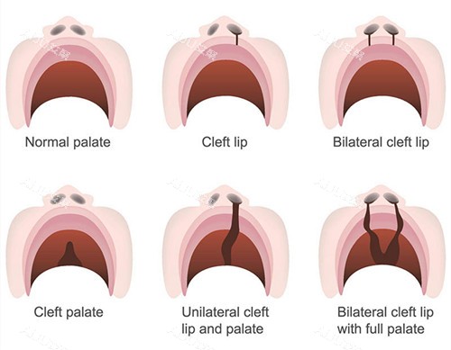 唇裂修复类型 唇裂修复类型
