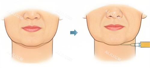 双下巴注射示图