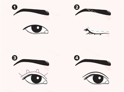 埋线双眼皮手术过程图 埋线双眼皮手术过程图