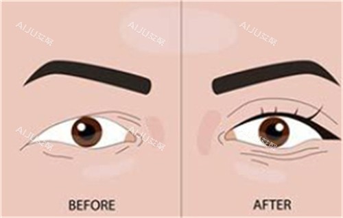 双眼皮手术前后对比 双眼皮手术前后对比