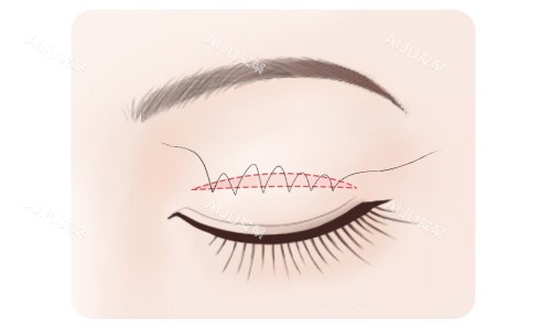 全切双眼皮缝合 全切双眼皮缝合