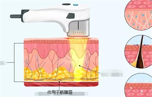 52%用户选择的超声治疗必坑指南来袭:适用人群+价格+优势一篇解答