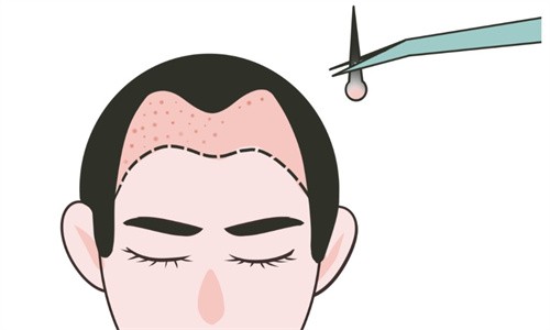 教你从植发技术+维持时间+适合人群来判断自己适合哪种植发方式！