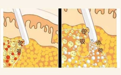 成都军大浦小兵吸脂技术怎么样？面部吸脂是特色审美先进脂肪抽取量把控较好
