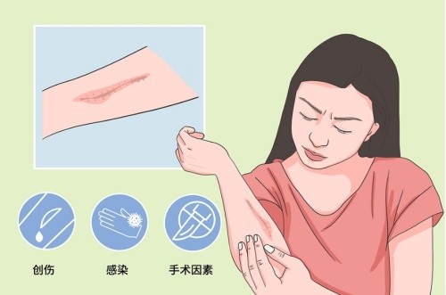 救命！疤痕增生是怎么回事？疤痕增生有什么影响？如何预防疤痕增生呢？