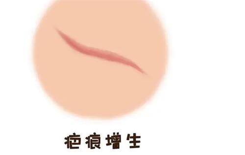 请看：疤痕增生如何完全消除？手术/非手术/综合治疗方法全都有