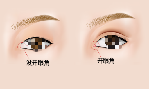攻略来啦！割眼角风险大吗？后遗症有哪些？手术费用多少钱？为你逐一阐述！割眼角全方位解析